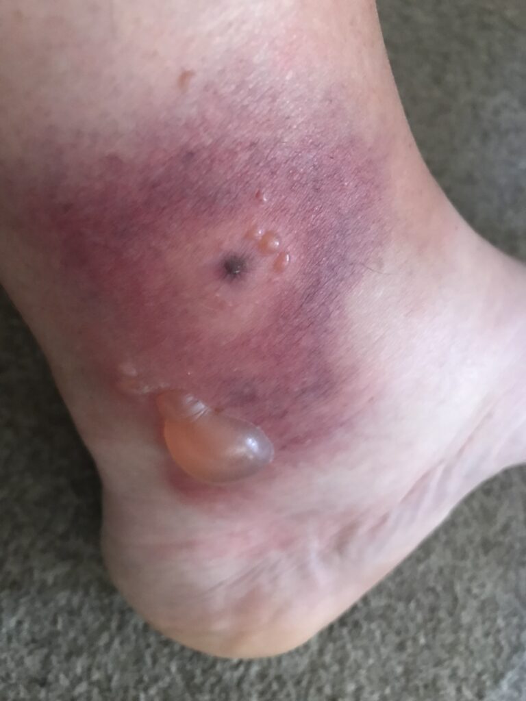blanford fly bite